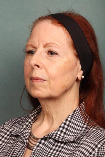 Facelift Before & After Patient #9181