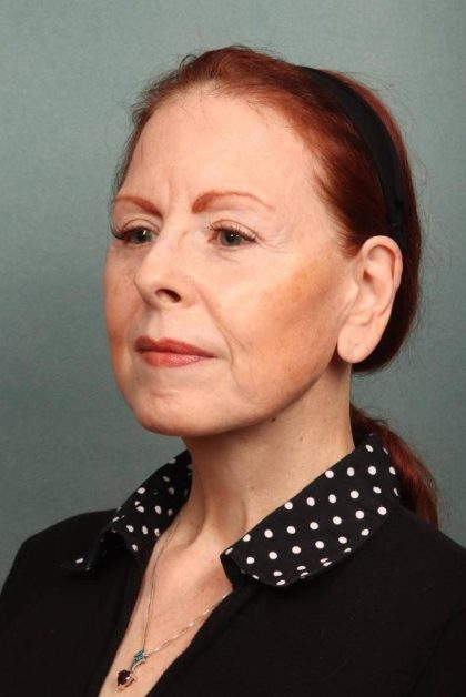 Facelift Before & After Patient #9181