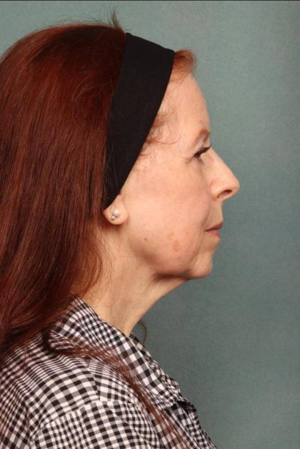 Facelift Before & After Patient #9181
