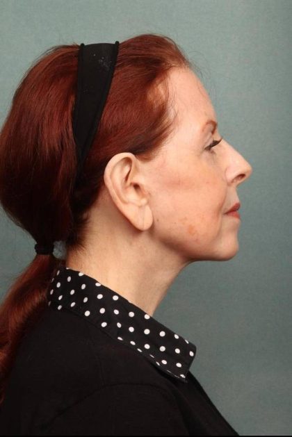 Facelift Before & After Patient #9181