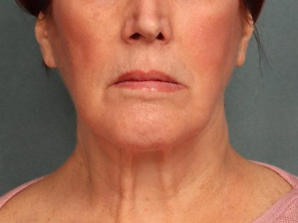 Facelift Before & After Patient #9182