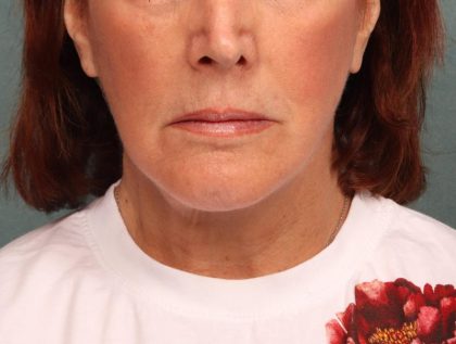 Facelift Before & After Patient #9182