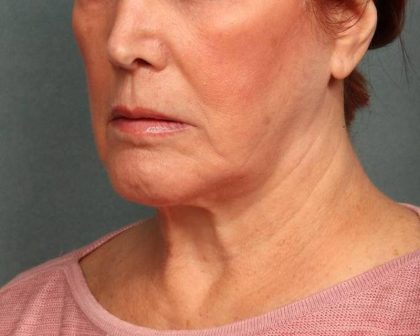 Facelift Before & After Patient #9182