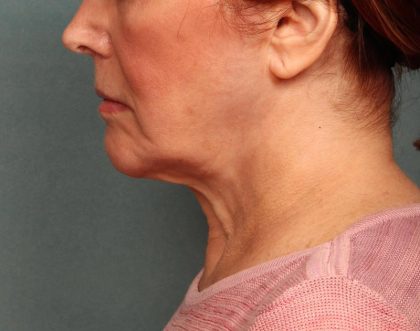 Facelift Before & After Patient #9182