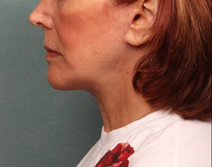 Facelift Before & After Patient #9182