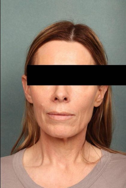 Facelift Before & After Patient #9183