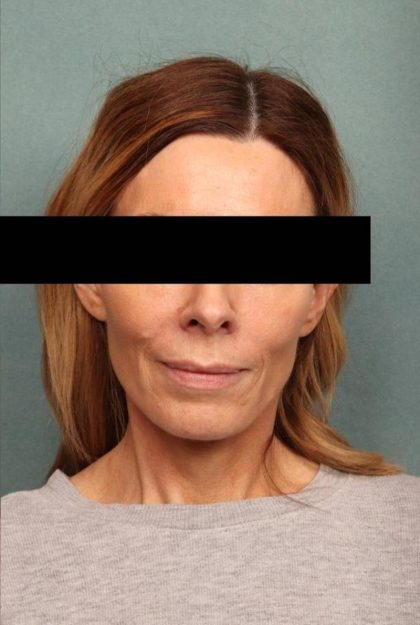 Facelift Before & After Patient #9183