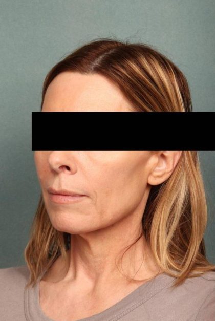 Facelift Before & After Patient #9183