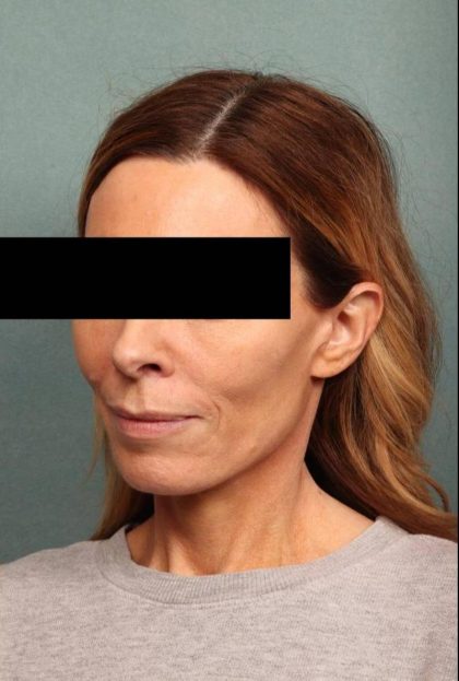 Facelift Before & After Patient #9183