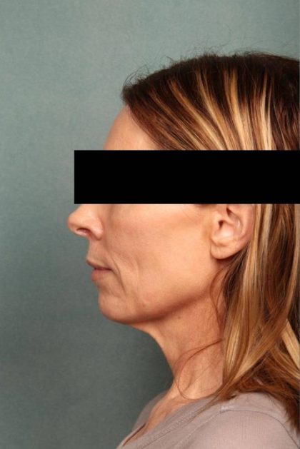 Facelift Before & After Patient #9183