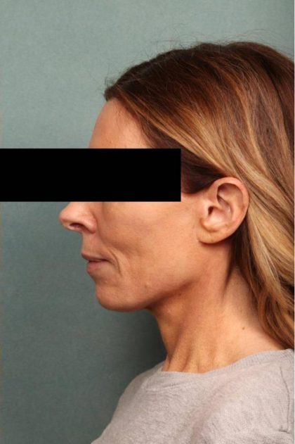 Facelift Before & After Patient #9183