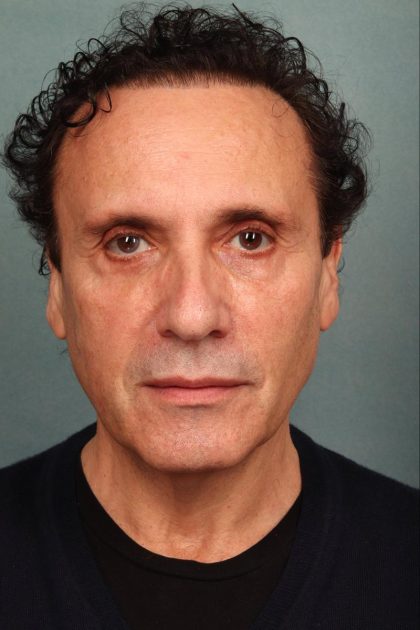 Facelift Before & After Patient #9184