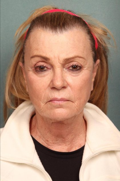 Facelift Before & After Patient #9185