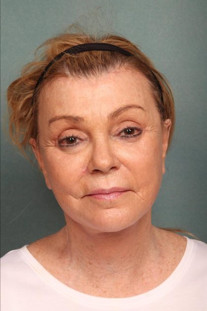 Facelift Before & After Patient #9185