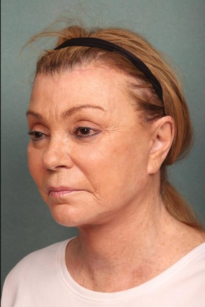 Facelift Before & After Patient #9185