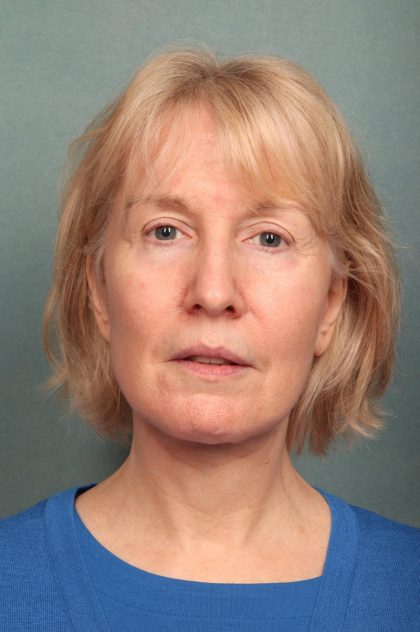 Facelift Before & After Patient #9188