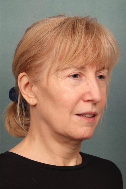 Facelift Before & After Patient #9188
