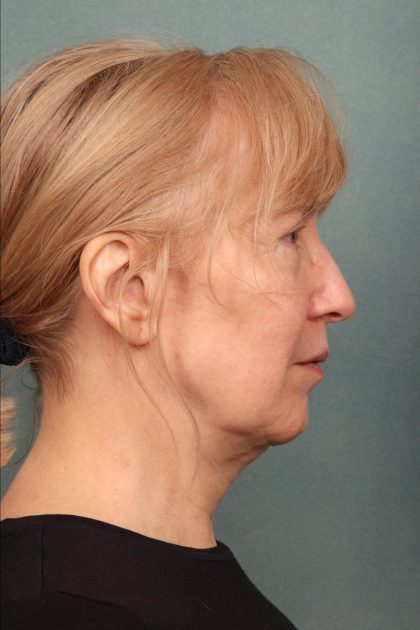 Facelift Before & After Patient #9188