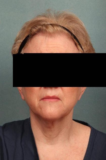Facelift Before & After Patient #9189