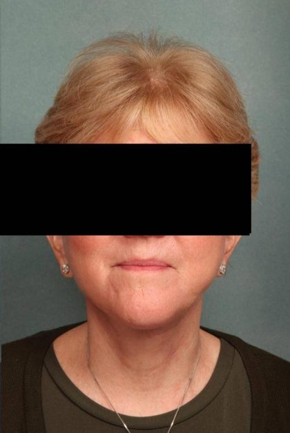 Facelift Before & After Patient #9189