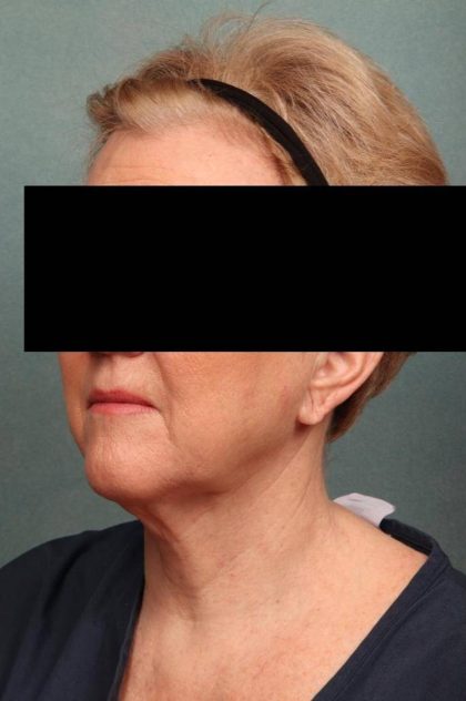 Facelift Before & After Patient #9189