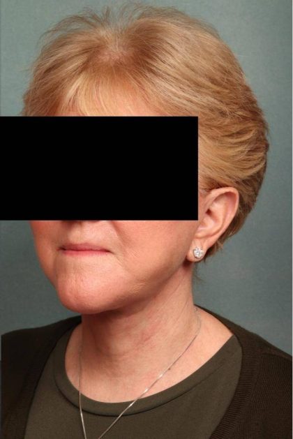 Facelift Before & After Patient #9189