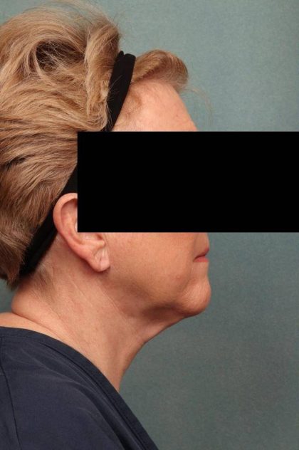Facelift Before & After Patient #9189