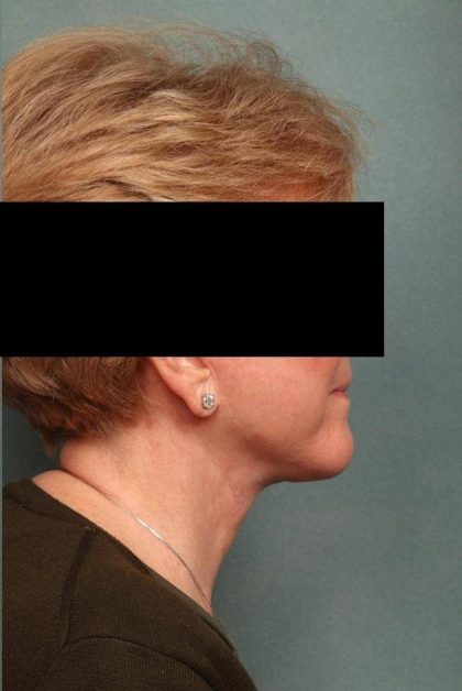 Facelift Before & After Patient #9189