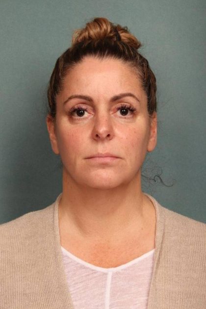 Facelift Before & After Patient #9177