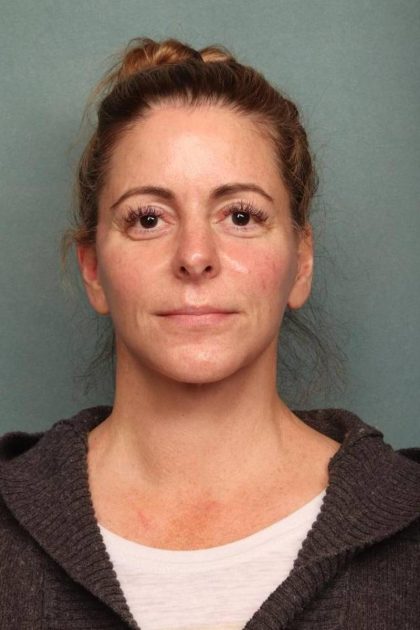 Facelift Before & After Patient #9177