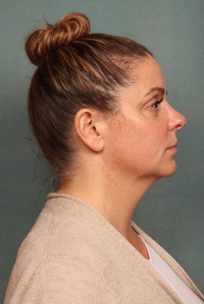 Facelift Before & After Patient #9177