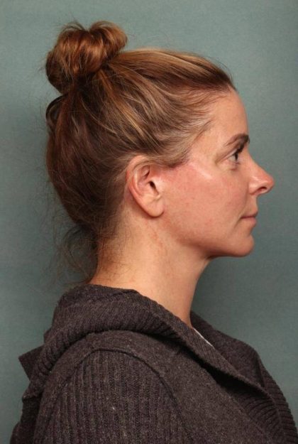 Facelift Before & After Patient #9177