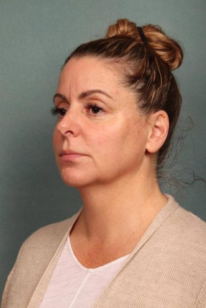 Facelift Before & After Patient #9177