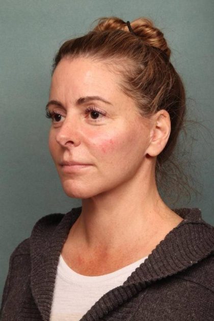 Facelift Before & After Patient #9177