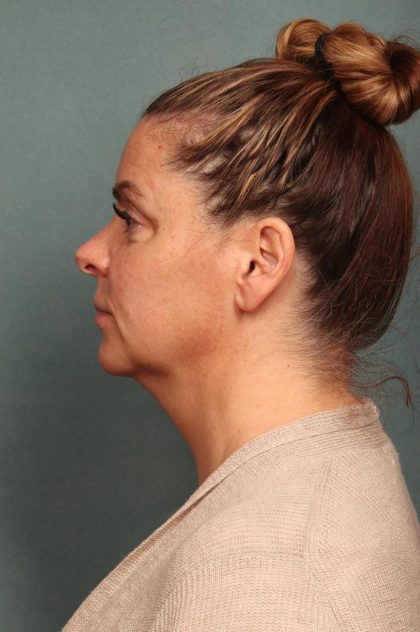 Facelift Before & After Patient #9177