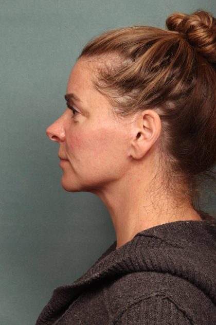 Facelift Before & After Patient #9177