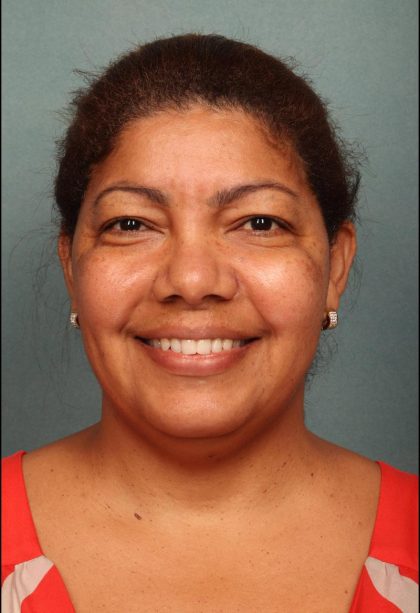 Facelift Before & After Patient #9190