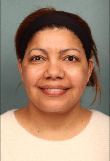 Facelift Before & After Patient #9190