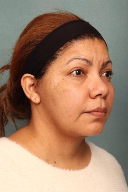 Facelift Before & After Patient #9190