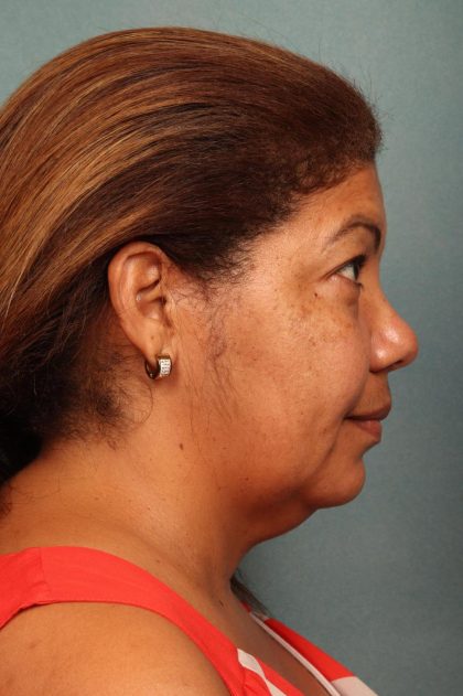 Facelift Before & After Patient #9190