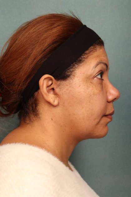 Facelift Before & After Patient #9190