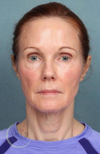 Facelift Before & After Patient #9192