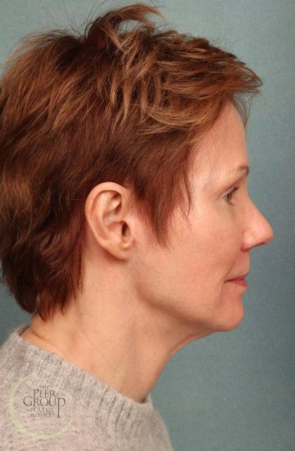 Facelift Before & After Patient #9192