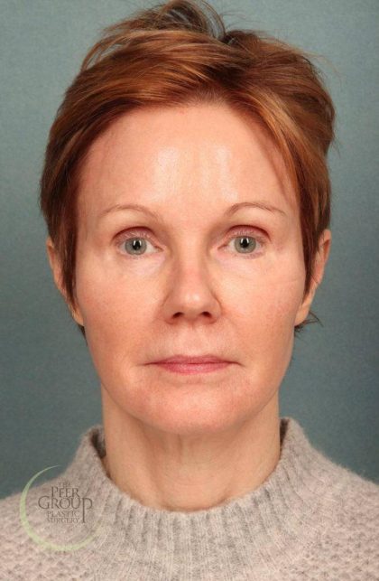 Facelift Before & After Patient #9192