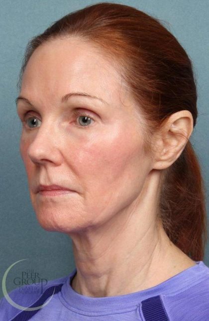Facelift Before & After Patient #9192