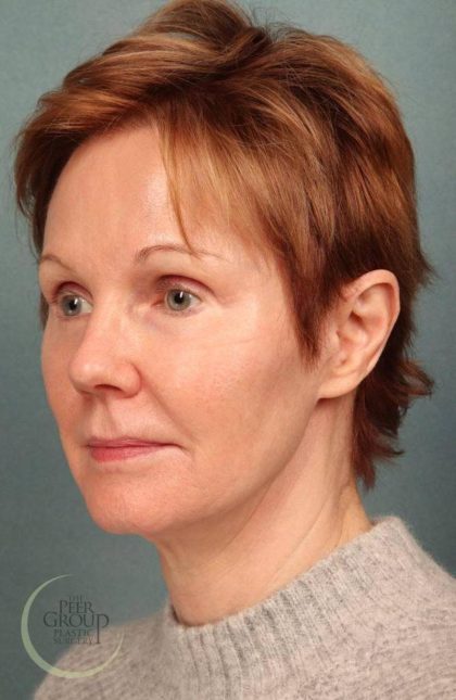 Facelift Before & After Patient #9192