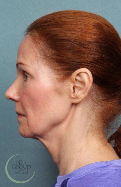 Facelift Before & After Patient #9192