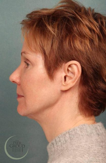 Facelift Before & After Patient #9192