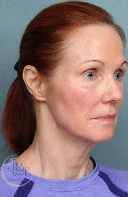 Facelift Before & After Patient #9192