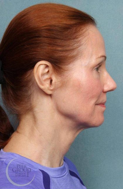 Facelift Before & After Patient #9192